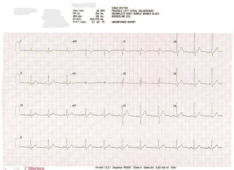 boardline ecg|borderline ecg left atrial enlargement.